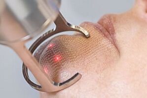 laser bidezko gaztetze zatikako teknologia